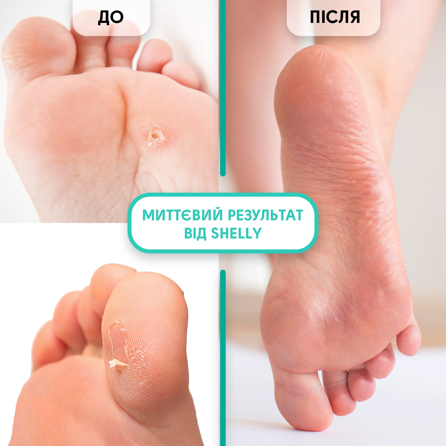 Foot Callus Softening Gel for Topical Application Soft Blade - 100 ml